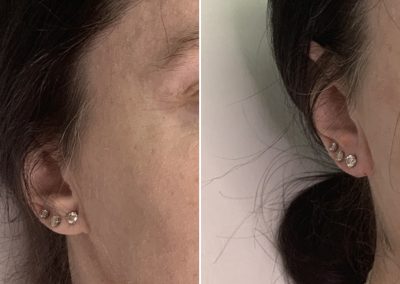 A before & after picture of bio-filler injected to ear lope to address aging, creases and uneven piercings.